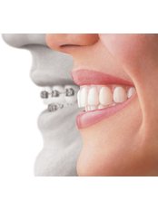 Removable Braces - Clarence House Dental Health Centre