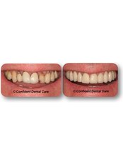 Implant Dentist Consultation - Confident Dental Implants