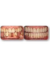 Implant Dentist Consultation - Confident Dental Implants