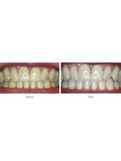 Professional Tray Tooth Whitening - Tewkesbury Dental