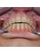 Caspian Dental Clinic - AFTER treatment with clear braces 