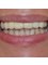 Caspian Dental Clinic - Smile makeover -AFTER 