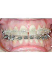 Adult Braces - Herts Orthodontics