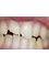 Herts Dental - Fractured teeth treatment 