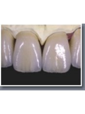 Porcelain Crown - Your Perfect Smile Dental Clinic Grantown branch