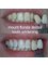 Mount Florida Dental - enlighten tooth bleaching 