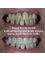 Mount Florida Dental - tooth whitening and emax crowns 