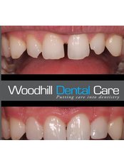 Dental Bonding - Woodhill Dental Care