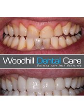 Dental Crowns - Woodhill Dental Care