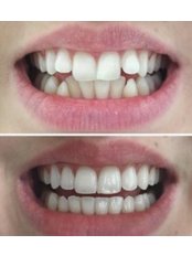 Clear Braces - Newland Dental Practice