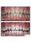 Broadway Dental Studio - Teeth whitening 