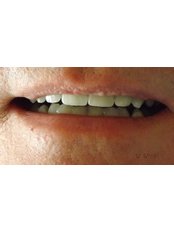 Dental Crowns - Camberdent ltd