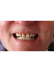 Dental Crowns - Camberdent ltd