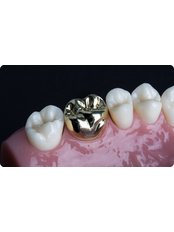 metal crowns - CBC Dental Studio