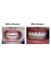Inlays and Veneers Porcelain - CBC Dental Studio