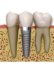 dental implants - CBC Dental Studio