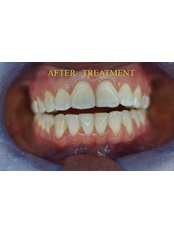 6MS after treatment picture - CBC Dental Studio