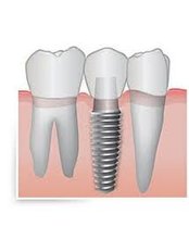 implant supported crown - CBC Dental Studio