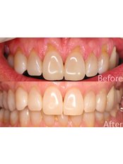 gum treatment - CBC Dental Studio
