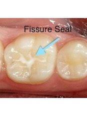 fissure sealant - CBC Dental Studio