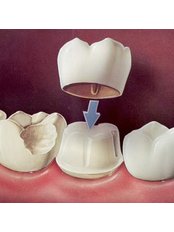 Porcelain bonded crown - CBC Dental Studio