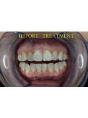 6MS before treatment picture - CBC Dental Studio