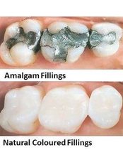 types of fillings - CBC Dental Studio