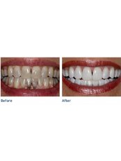 Teeth Cleaning - CBC Dental Studio