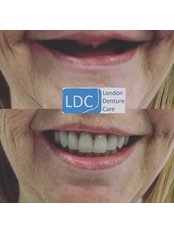 Acrylic Dentures - London Denture Care