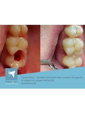 Fillings - Forest & Ray - Dentists, Orthodontists, Implant Surgeons