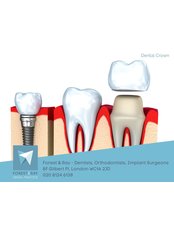 Dental Crowns - Forest & Ray - Dentists, Orthodontists, Implant Surgeons