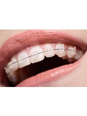Ceramic Braces - Forest & Ray - Dentists, Orthodontists, Implant Surgeons