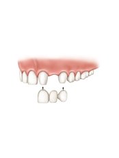 Porcelain Bridge - Forest & Ray - Dentists, Orthodontists, Implant Surgeons