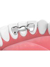 Maryland Bridge - Forest & Ray - Dentists, Orthodontists, Implant Surgeons
