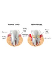 Periodontitis Treatment - Forest & Ray - Dentists, Orthodontists, Implant Surgeons