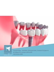 Single Implant - Forest & Ray - Dentists, Orthodontists, Implant Surgeons