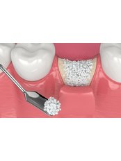 Bone Graft - Forest & Ray - Dentists, Orthodontists, Implant Surgeons
