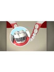 Metal Braces - Forest & Ray - Dentists, Orthodontists, Implant Surgeons
