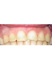 Teeth Contouring and Reshaping - Dr Alan Sidi