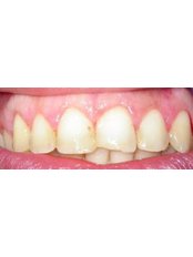 Teeth Contouring and Reshaping - Dr Alan Sidi