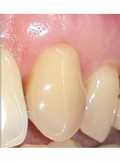 Gum Contouring and Reshaping - Dr Alan Sidi