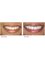 Wimpole Dental - Teeth Whitening 