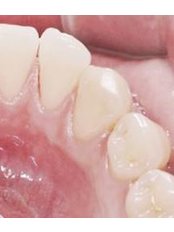 Periodontitis Treatment - Palcare Dental Practice