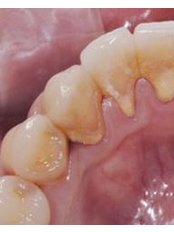 Periodontitis Treatment - Palcare Dental Practice