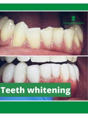 Teeth Whitening - SW11 Medical