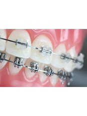 Six Months Braces (All inclusive) - ODL Dental Clinic