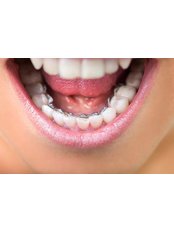 Lingual Braces  - ODL Dental Clinic