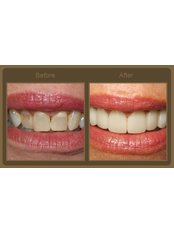 Veneers Before and After - RightChoice