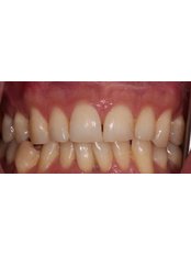 Zoom! Teeth Whitening - IKON Dental Specialists