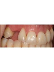 Dental Implants - IKON Dental Specialists